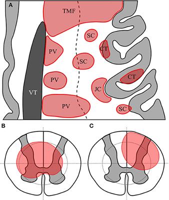 MRI Patterns Distinguish AQP4 Antibody Positive Neuromyelitis Optica Spectrum Disorder From Multiple Sclerosis